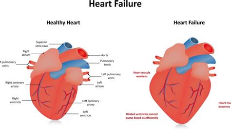 what is hypokinesis in cardiology.